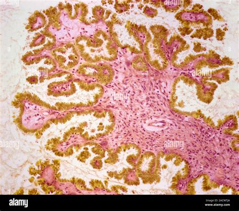 Ovarian Tumour Light Micrograph Of A Section Through An Ovary Showing