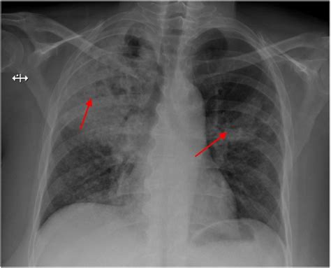 Primary Care CXR: CXR from initial immediate care visit one month prior ...