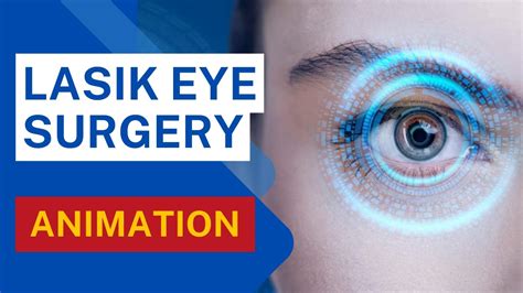 Lasik Surgery Animation Lasik Surgery Procedure Lasik Specs Removal