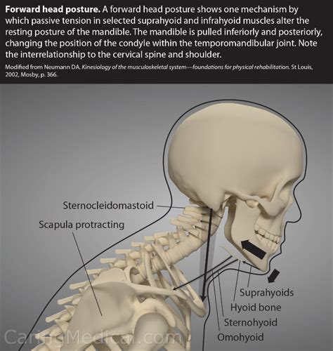 Forward Head Posture Exercises Correcting