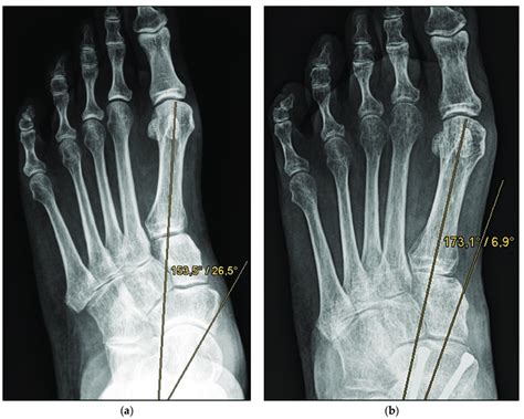 Pre And Post Operative Radiographic Findings Of Combined Talonavicular