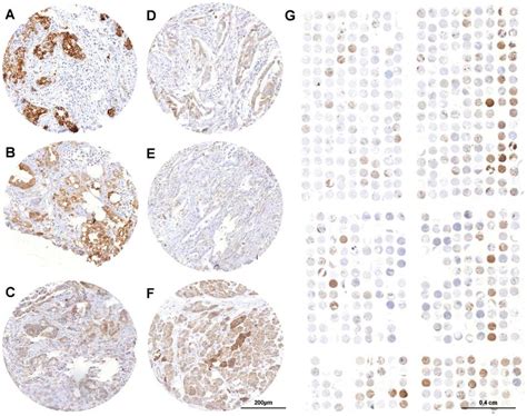 Representative Immunohistochemical Alcam Stains Of Primary Pancreatic Download Scientific