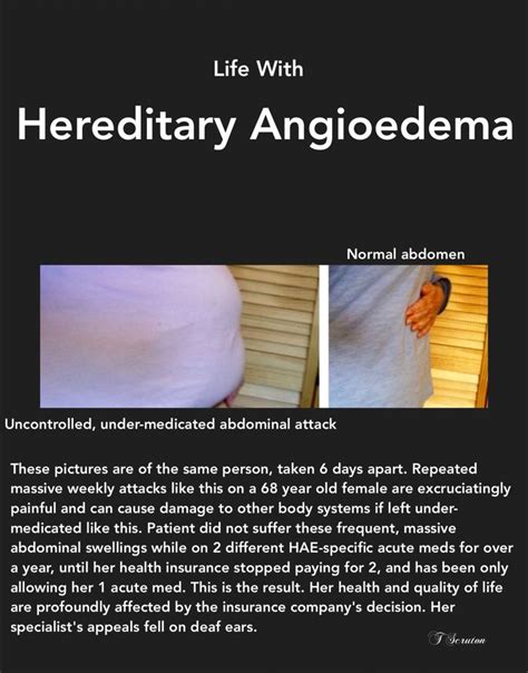 Hereditary Angioedema Chronic Illness Inherited Disease Chronic Pain