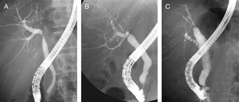 Biliary Anastomotic Stricture After Adult Living Donor Liver