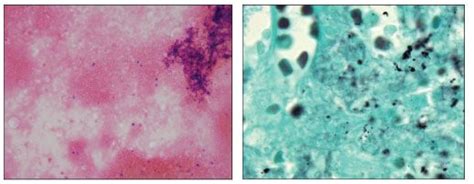 Splenic Pneumocystosis An Atypical Presentation Of Extrapulmonary Pneumocystis Infection