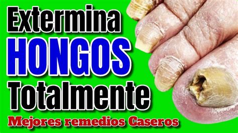 Como Quitar Hongos Delos Pies Y El Mal Olor Remedios Caseros Tratamiento Natural 2025 Youtube