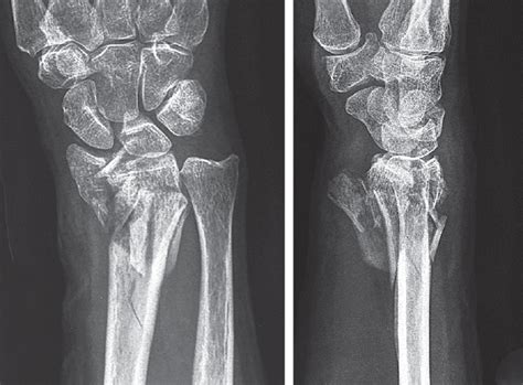 Comminuted Metaphysealdiaphyseal Fractures Musculoskeletal Key