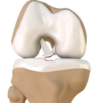 Tibial Eminence Fractures Monterey | Open Reduction and Fixation Salinas