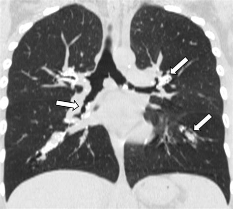 Amyloidosis Multisystem Spectrum Of Disease With Pathologic