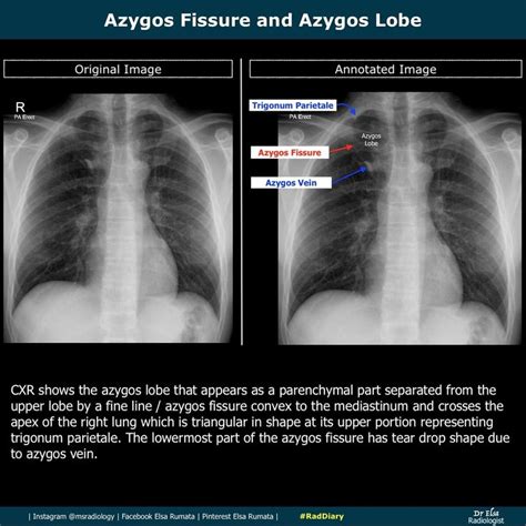 Azygos Fissure And Azygos Lobe