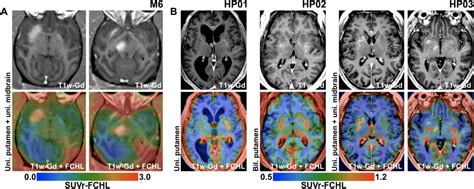 Gene Therapy Breakthrough In Parkinsons Disease Focused Ultrasound