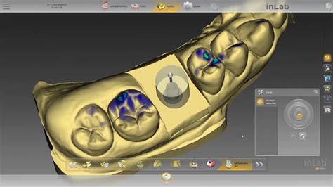 Digital Custom Abutment And Crown On Tibase Scan Body Inlab Dentsply