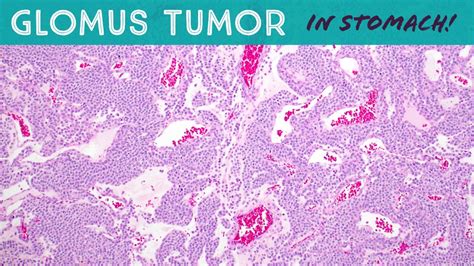 Glomus Tumor Of The Stomach