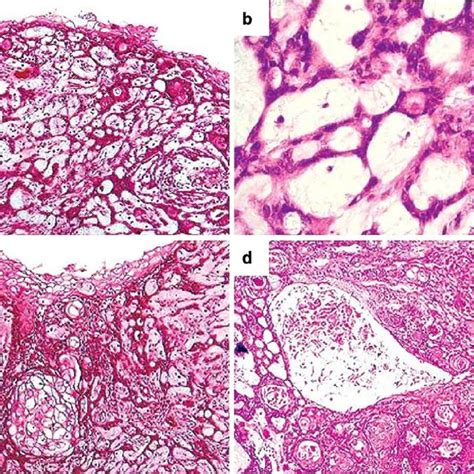 Histological aspects of the tumor. Morphologically, different ...