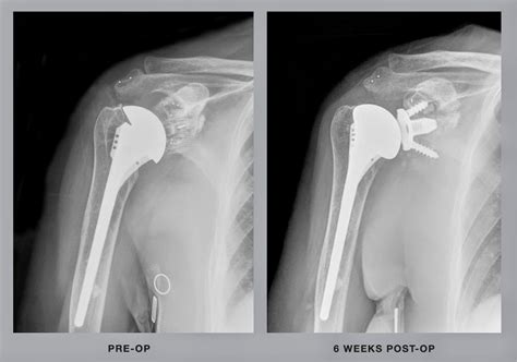 Artroplastia Ombro Enfermagem Em Ortopedia