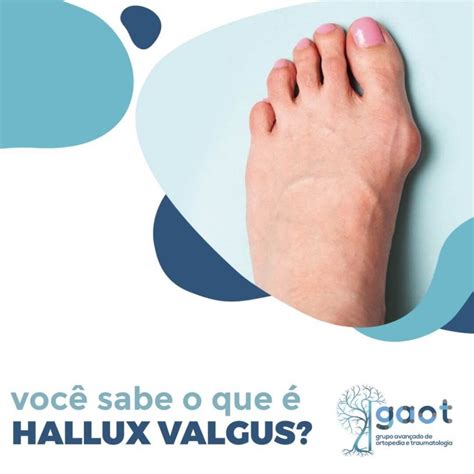 Voc Sabe O Que Hallux Valgus Gaot