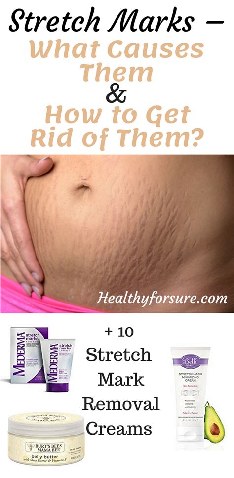 Stretch Marks What Causes Them And How To Get Rid Of Them Best Stretch Mark Removal