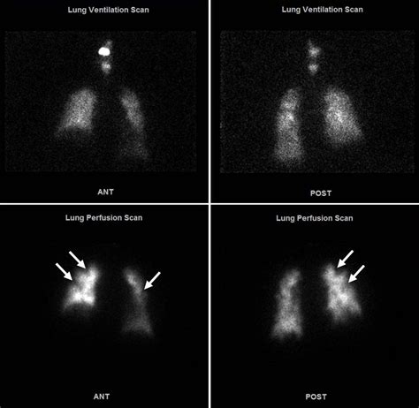 Ventilation Perfusion Lung Scan Anterior View A And Posterior View