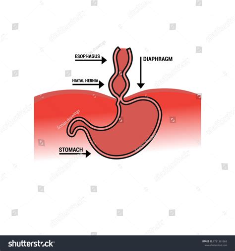 Image Hiatus Hernia Descriptive Icon Disease Stock Vector (Royalty Free
