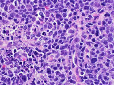 Pathology Outlines - High grade B cell lymphoma, NOS