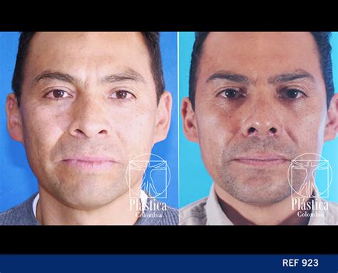 Mentoplastia Casos Hombre Plastica Colombia