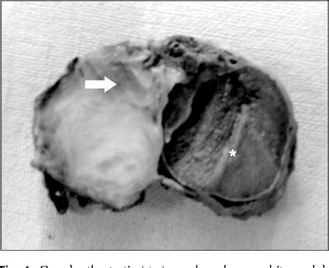 Figure 1 From A Case Of Fibrous Pseudotumor Of The Paratesticular