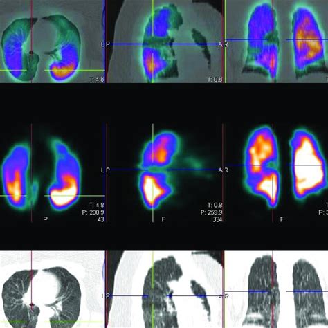 Perfusion Single Photon Emission Computed Tomography Computed