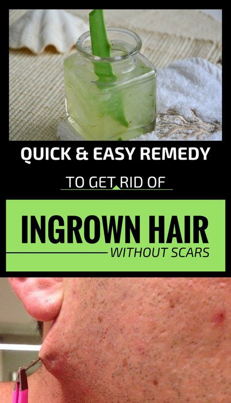 Improve Your Skin With These Great Tips Ingrown Hair Remedies Ingrown Hair Remedies