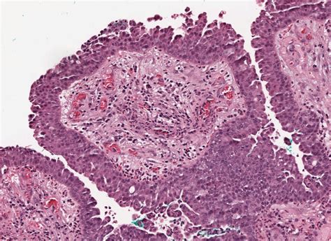 Pathology Outlines Syringocystadenoma Papilliferum