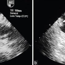 Transesophageal Echocardiogram Modified Midesophageal Bicaval View