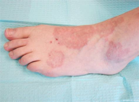 The Granuloma Annular Disease Is A Very Rare Disorder Chronic