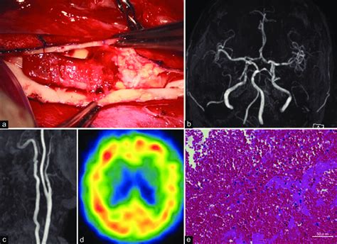 A Operative View Of Carotid Endarterectomy Cea Showing Calcified