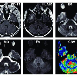 Axial Post Contrast T1 Weighted Image Demonstrating A Bilobed