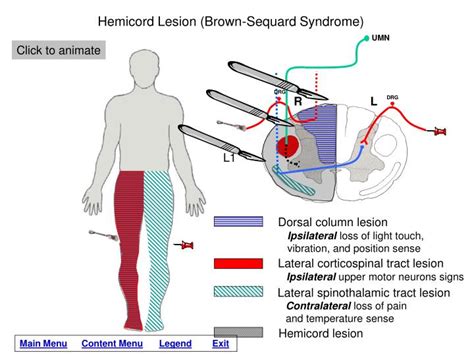 PPT Lesions Of The Spinal Cord PowerPoint Presentation ID 1265796