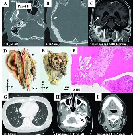 Representative Case A B Preoperative Axial Computed Tomography