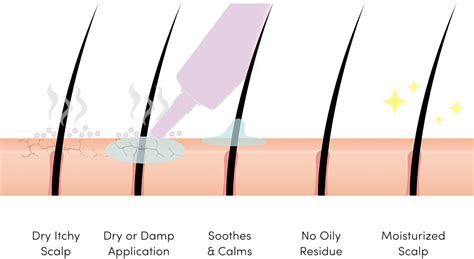 Dandruff Scalp Diagram