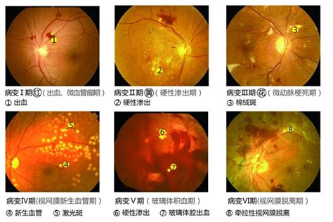 糖尿病视网膜病变 健康160