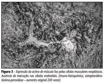 Scielo Brasil Leiomioma Vascular Bucal Relato De Dois Casos