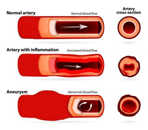 symptoms of aneurysm in head | Dentgap