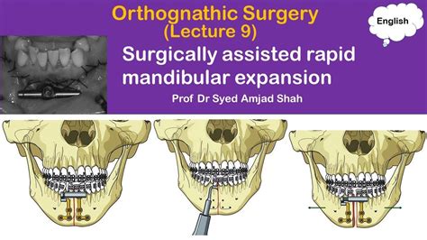 Surgically Assisted Rapid Mandibular Expansion Orthognathic Surgery