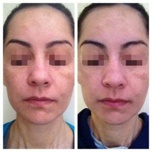 Suavicid Antes E Depois Melasma Manchas E Espinhas