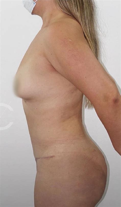 Lipoabdominoplast A Doctor Juan Pablo Cisternas Cirujano Pl Stico