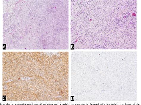 Figure 3 From Solitary Intraosseous Myofibroma Of The Tibia In An Adult Patient A Case Report