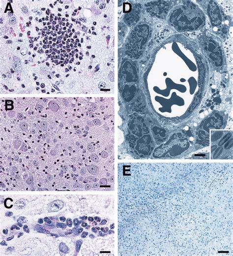 Neutrophil And Eosinophil Infiltration In The Cns Of Mbpccl21