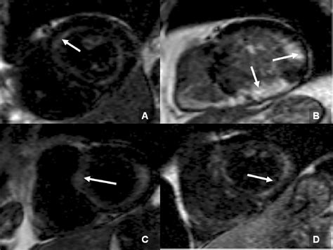 Lge Patterns Using Mag Ir Imaging A Characteristic Global