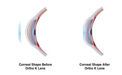 Orthokeratology Ortho K In2eyes Optometry