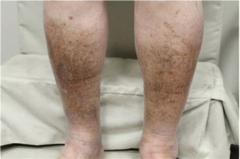 Venous Stasis Dermatitis Cellulitis