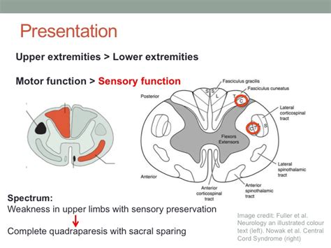 Central Cord Syndrome