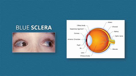 Blue Sclera Pathology And Its Causes Remember Mnemonic Blue Is A