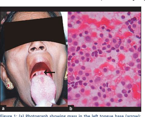 Figure 1 From Fine Needle Aspiration Diagnosis Of Extranodal Non Hodgkins Lymphoma Of The